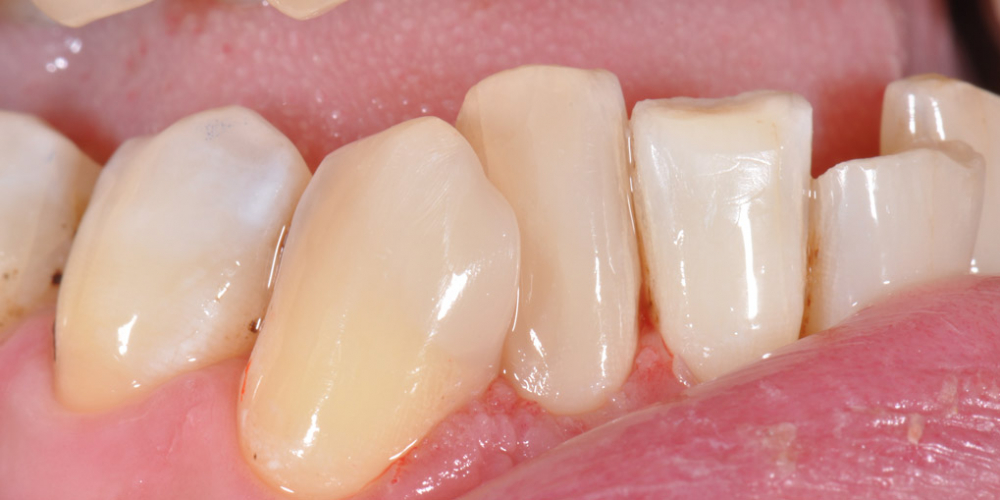  Периодически возникающие боли от холодного и горячего в области двух зубов