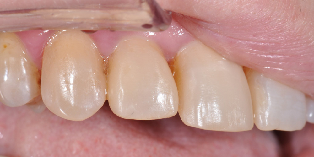  Жалобы на неудовлетворительный внешний вид передних зубов