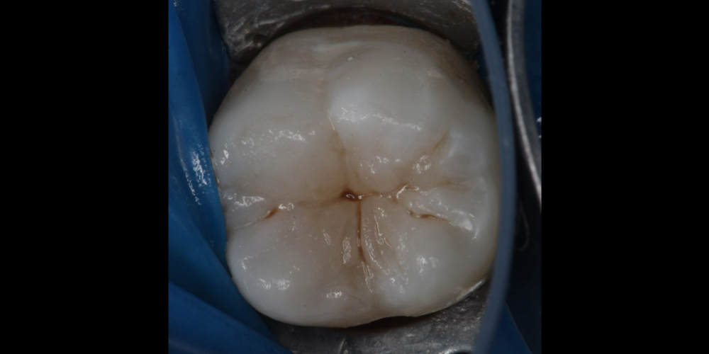  Лечение кариеса 46 зуба
