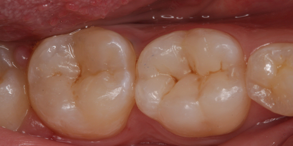  Лечение кариеса двух зубов в одно посещение