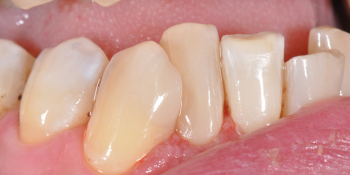 Периодически возникающие боли от холодного и горячего в области двух зубов фото после лечения