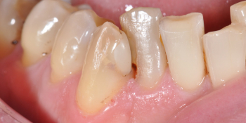 Периодически возникающие боли от холодного и горячего в области двух зубов фото до лечения