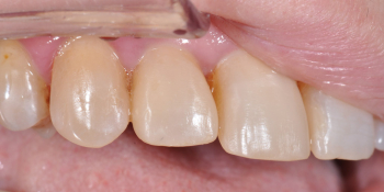 Жалобы на неудовлетворительный внешний вид передних зубов фото после лечения