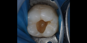 Лечение кариеса 46 зуба фото до лечения