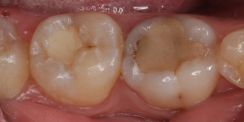 Лечение кариеса двух зубов в одно посещение фото до лечения