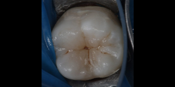 Лечение кариеса 46 зуба фото после лечения