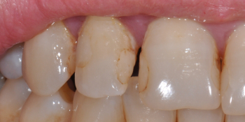 Жалобы на неудовлетворительный внешний вид передних зубов фото до лечения