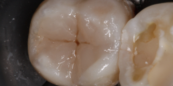 Жалобы на боли при накусывании в области 37 зуба фото после лечения